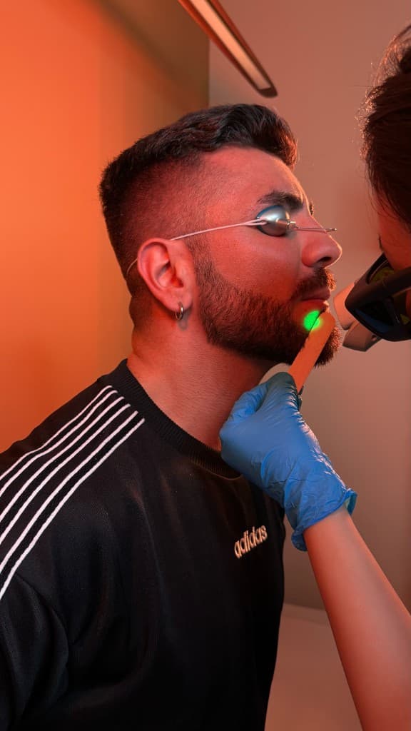 Men's beard laser hair removal treatment