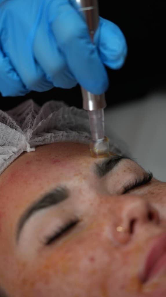 Micro Needling with Biorepeel